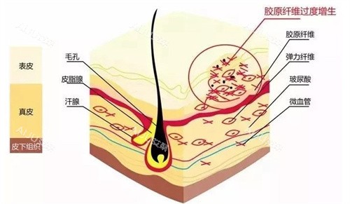 增生疤痕示意图 增生疤痕示意图