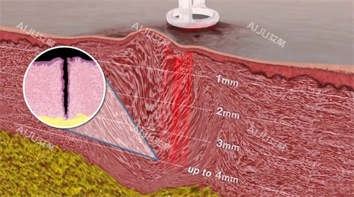 皮肤内的疤痕纹理 皮肤内的疤痕纹理