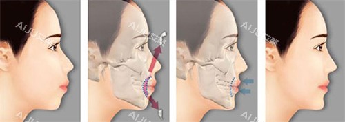 双鄂手术前后对比图片