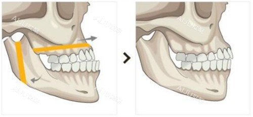 双鄂手术前后对比