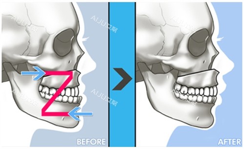 双鄂手术的过程及对比