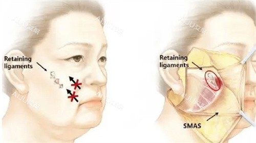 筋膜悬吊怎么做的 筋膜悬吊怎么做的