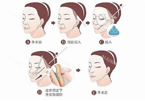 筋膜悬吊手术过程 筋膜悬吊手术过程