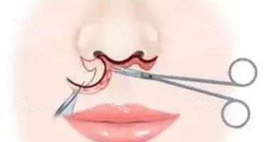 埋线人中缩短术手术过程图解