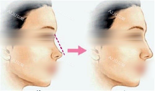 鼻背隆鼻填充前后对比图