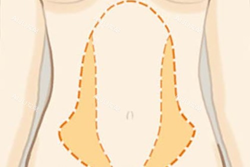 腰腹吸脂位置示意图