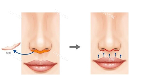 人中缩短手术切除部位