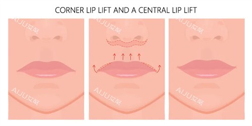 人中缩短手术动画图示