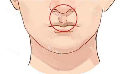 人中加深手术后
