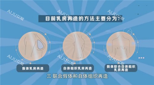 乳房再造手术方式