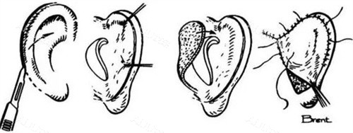 耳再造手术过程 耳再造手术过程