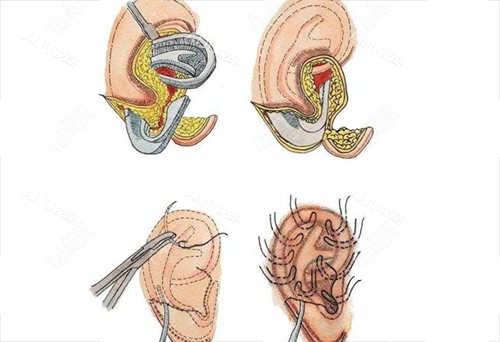 耳再造手术步骤展示 耳再造手术步骤展示