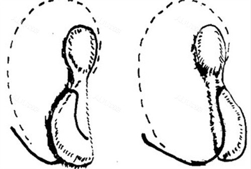 小耳再造手术 小耳再造手术