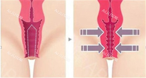 私密紧缩手术前后对比差异 私密紧缩手术前后对比差异
