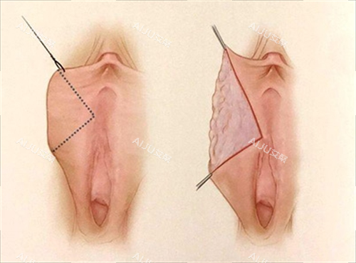 女性私密手术动画展示