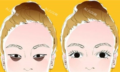 眼袋明显对比图 眼袋明显对比图