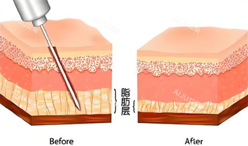 吸脂手术脂肪层对比