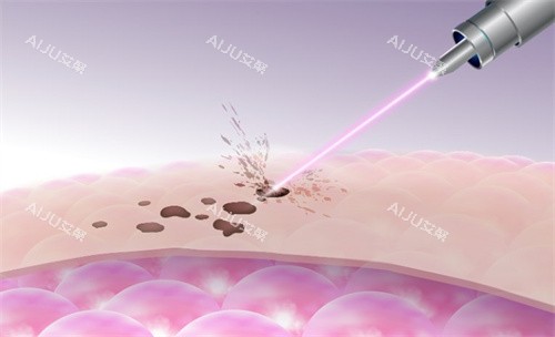 激光祛斑原理图 激光祛斑原理图