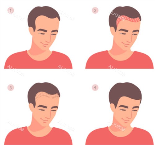 发际线植发前后图解 发际线植发前后图解