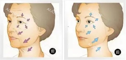 面部抗衰对比图 面部抗衰对比图