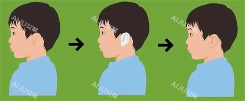 小耳畸形手术前后对比 小耳畸形手术前后对比