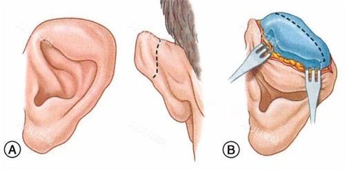 耳畸形矫正术 耳畸形矫正术