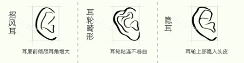 耳畸形种类 耳畸形种类