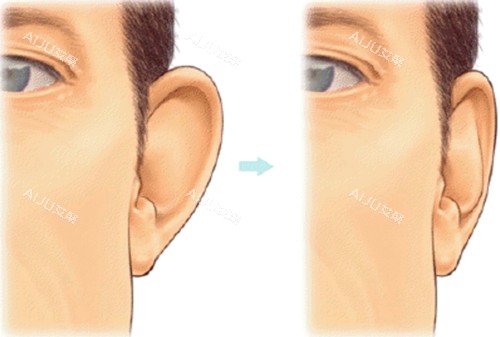 招风耳耳畸形 招风耳耳畸形