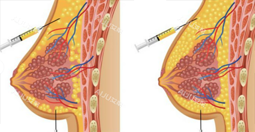 胸部奥美定注射物
