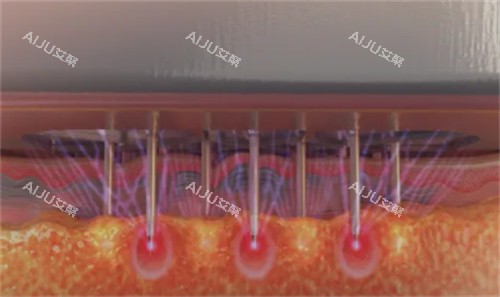 黑曜双波黄金微针怎么样