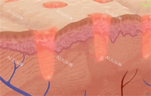 黑曜双波黄金微针治疗过程