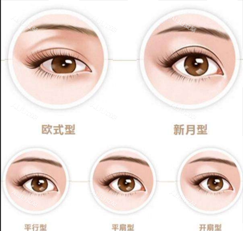 双眼皮类型图示 双眼皮类型图示