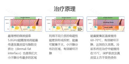 清新微波去腋臭技术原理图解 清新微波去腋臭技术原理图解