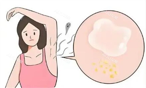 腋臭卡通图照片示意图 腋臭卡通图照片示意图