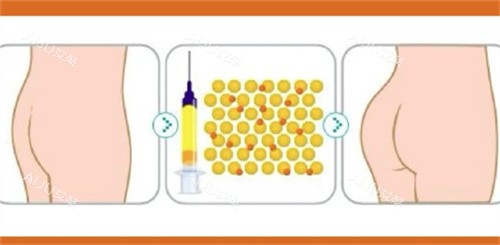 自体脂肪丰臀对比