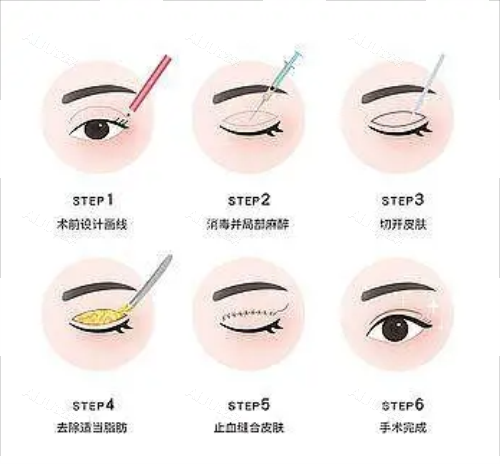 全切双眼皮流程图示