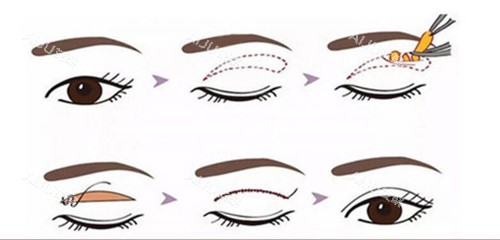 全切双眼皮过程示意图