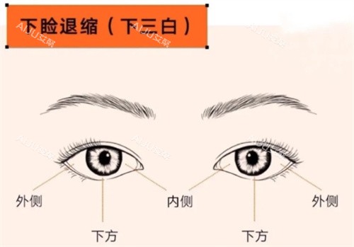 眼修复下睑退缩
