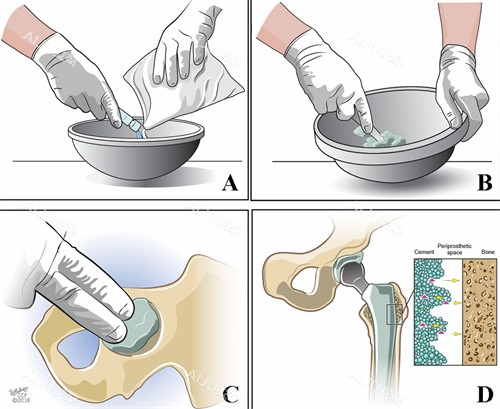 骨水泥修复过程