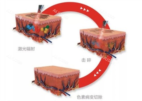 去纹身原理 去纹身原理
