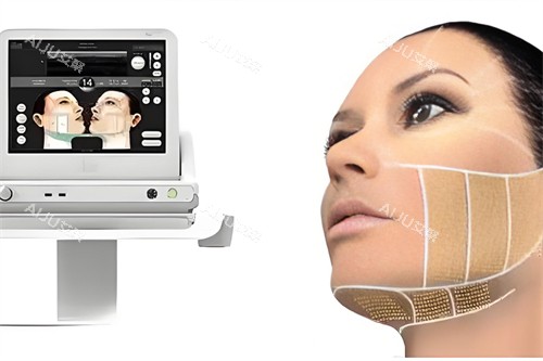 ulthera 超声提拉