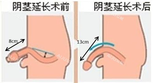 阴茎增长手术前后对比动画图