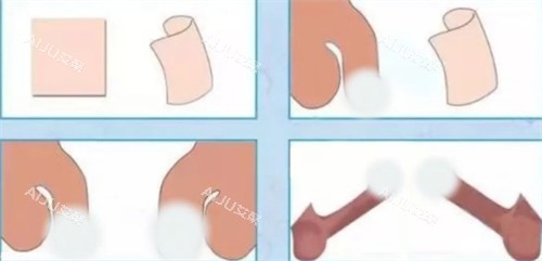 阴茎生物补片手术前后对比