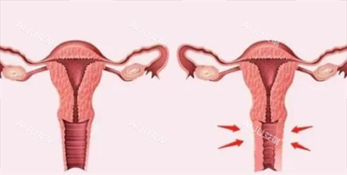 3D生物束带紧缩术对比图