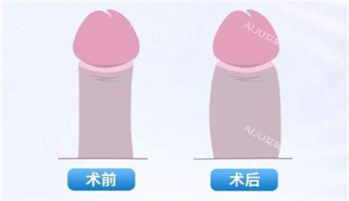 男性私密脂肪填充