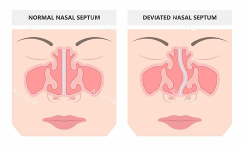 鼻修复手术前后对比 鼻修复手术前后对比