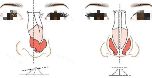 歪鼻修复矫正示意图 歪鼻修复矫正示意图