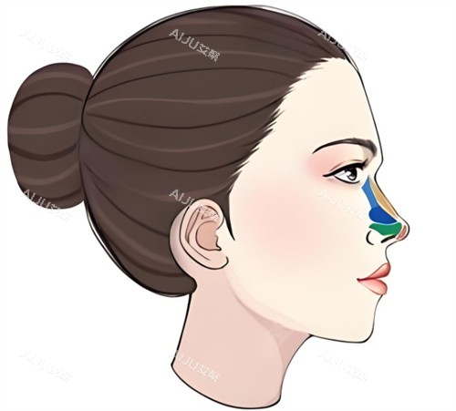 隆鼻修复图 隆鼻修复图