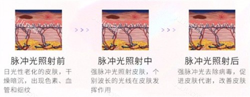 光子嫩肤对比