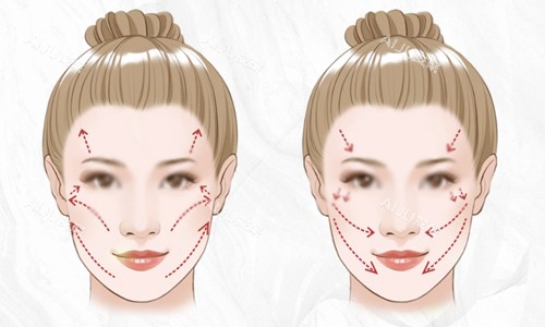面部轮廓衰老下垂示意图